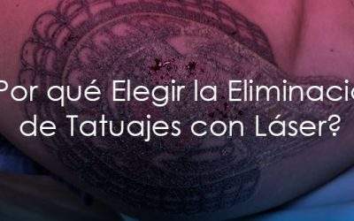 Eliminación de Tatuajes con Láser: Tu Camino Hacia una Piel Sin Tatuajes