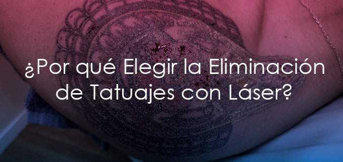 Eliminación de Tatuajes con Láser: Tu Camino Hacia una Piel Sin Tatuajes