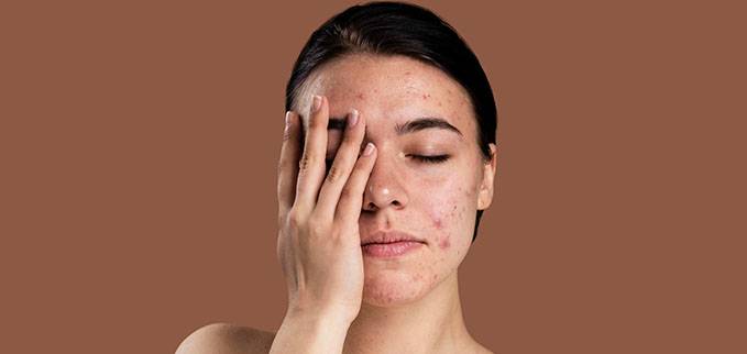 mujer con marcas de acné en el rostro