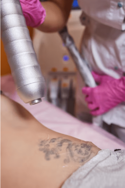 eliminando un tatuaje en albacete barato