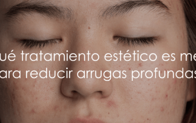 Láser vs. Peeling Químico: ¿Qué tratamiento es más efectivo para manchas?