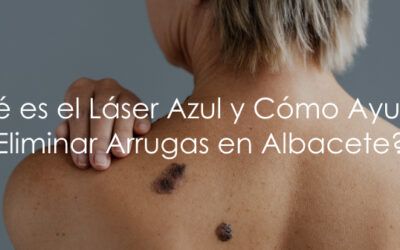 ¿Qué es el Láser Azul para Eliminar Arrugas y Cómo Funciona? – Tratamientos Estéticos en Albacete