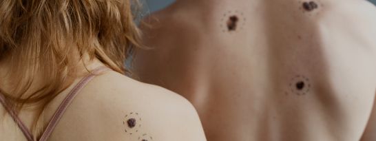 laser azul para eliminar verrugas y manchas. Rejuvenecer la piel en albacete