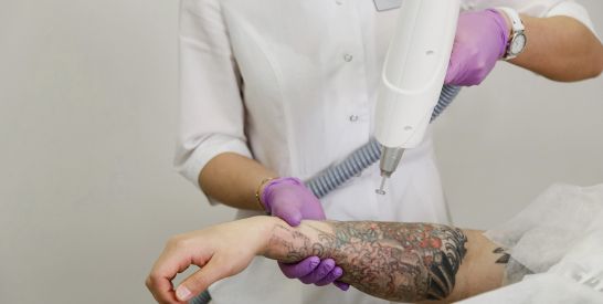 clínica médico estética en Albacete especializada en eliminación de tatuajes con láser