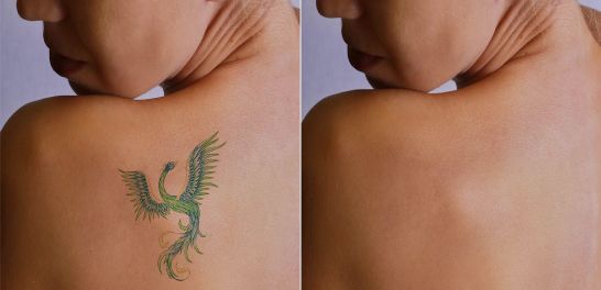 eliminación de tatuajes con láser en Albacete en centro médico estético